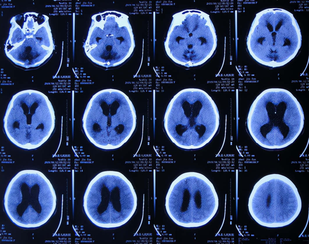 脑出血后脑积水会造成意识不清吗,脑出血后脑积水发高烧危险期多久