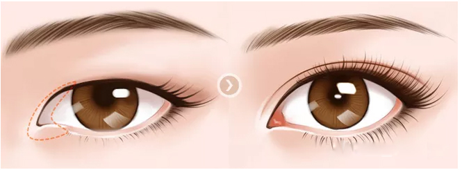 睑裂短内眦距离较宽,内眦严重但眼距窄怎么办