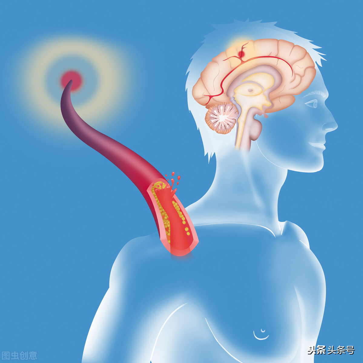 防治脑血管病的中药,有治疗脑血管疾病的中药吗