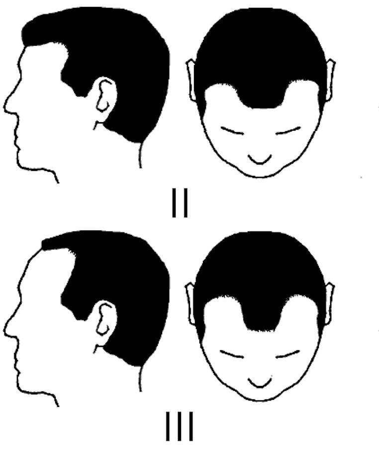 中年男性脱发原因及治疗方法,中年男性遗传性脱发能治好吗