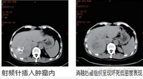 介入疗法的未来前景,介入治疗快速发展