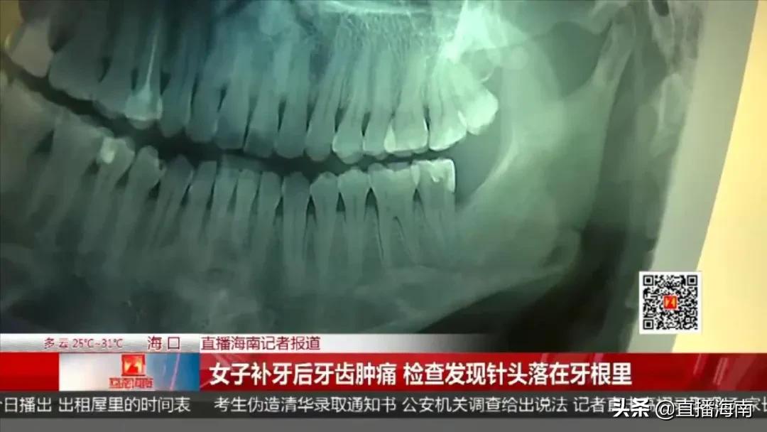 细思极恐！女子补牙后牙齿肿痛，检查发现3毫米针头落在牙根里