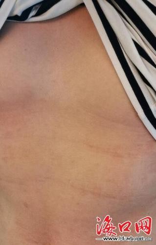 酒店回应客人被蜈蚣咬伤,客人在酒店被马蜂蜇了