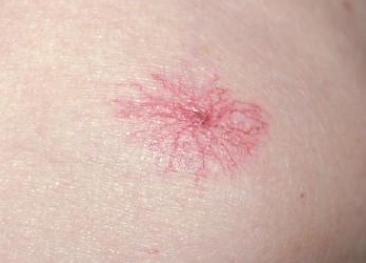 肝癌长痣,肝癌患者身上出现红痣代表什么