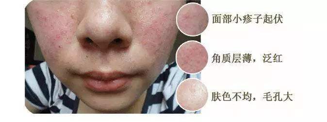 老中医化妆品能修复激素脸吗,老中医治疗激素脸