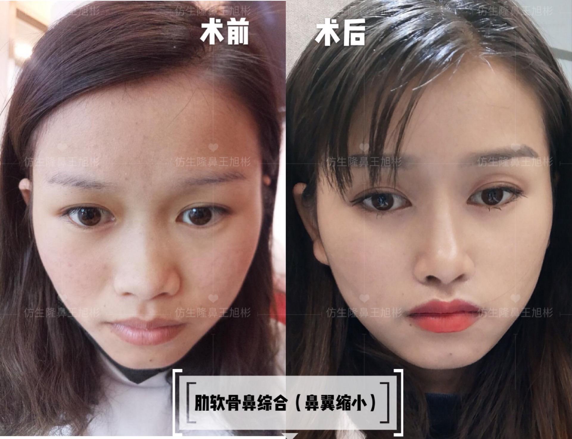 山根低鼻头大隆鼻,鼻根很低的隆鼻后的效果