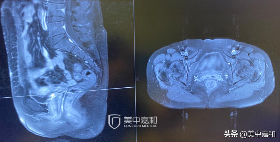 癌症手术很成功有可能复发吗,手术成功的小秘诀