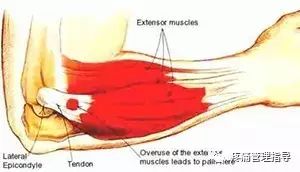 网球肘能自我恢复吗,网球肘病因的解剖学研究