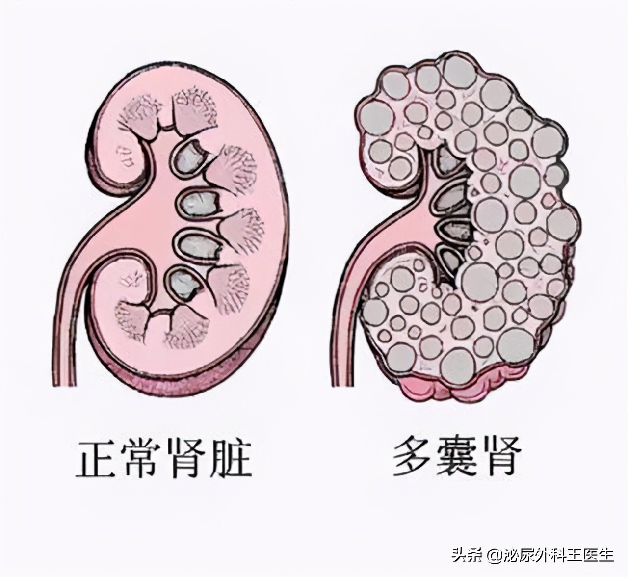 体检发现肾囊肿怎么办,体检中常见肾囊肿怎么治疗
