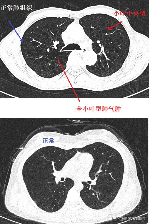 肺气肿治疗权威专家,老年人肺部疾病有哪些