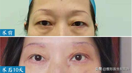 眼皮耷拉除了提眉还有什么办法,眼皮松弛下垂想提眉是需要动刀不