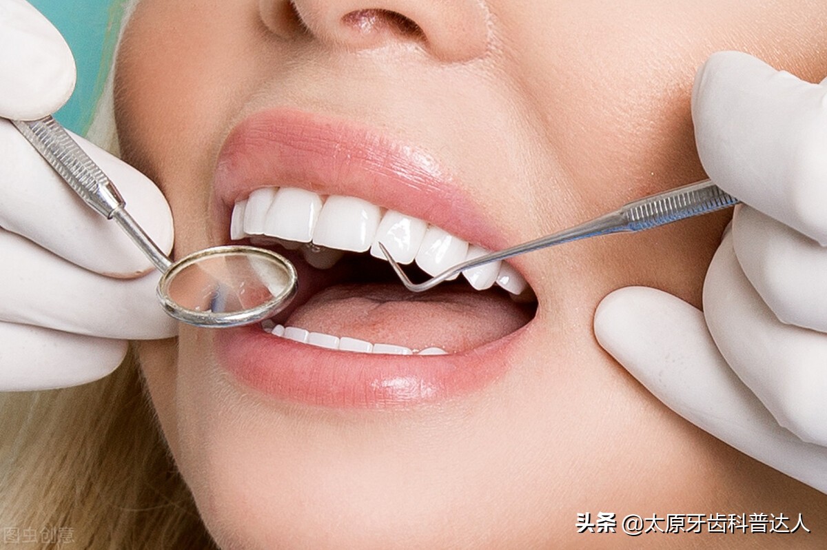 氟斑牙能洗牙吗,洗牙能去除牙菌斑吗