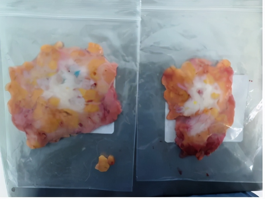 两个乳房发育不一致正常吗,乳房发育后才长腋毛正常吗