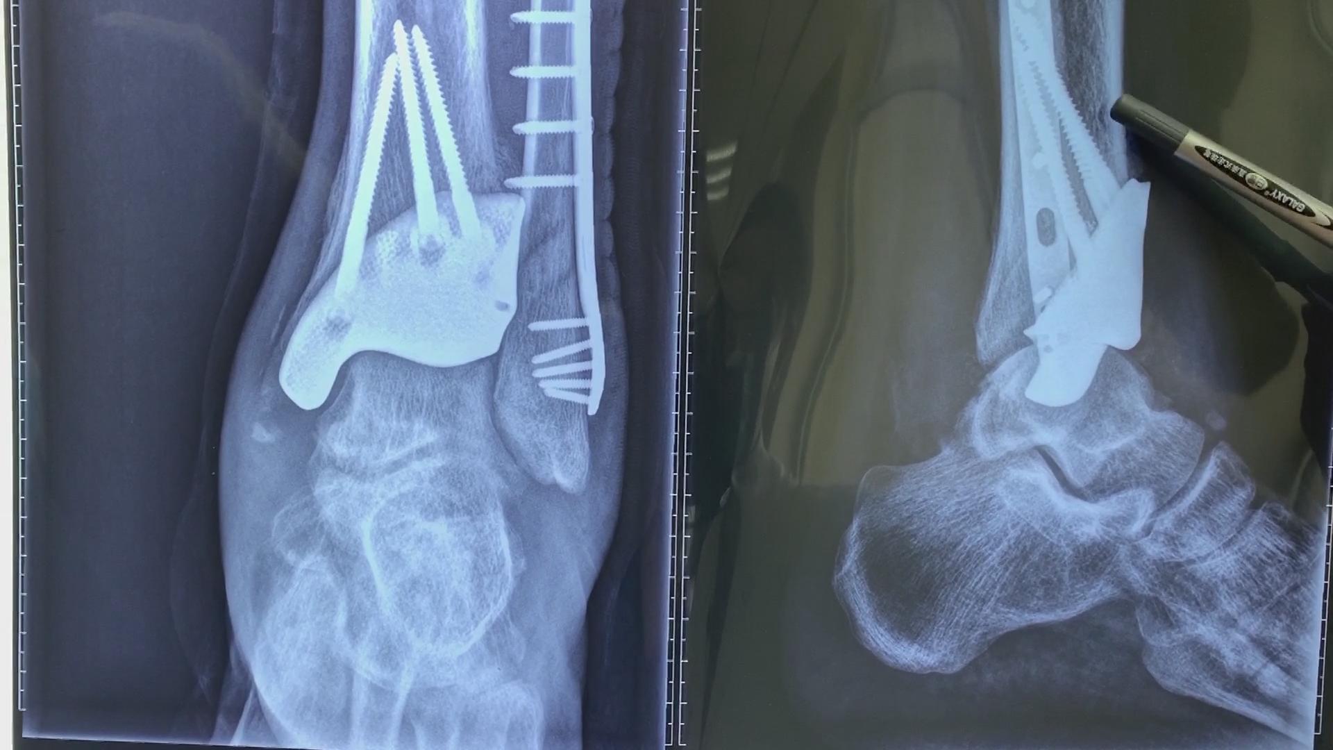 沈阳小伙小拇指骨折,沈阳小伙崴脚