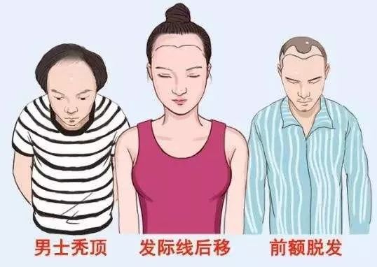 女的发际线后移的原因中医,女性脱发严重发际线后移