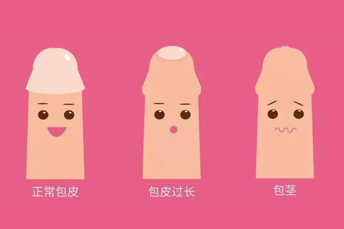 包皮过长是必须进行割包皮手术吗,包皮过长又不想割包皮有好办法吗