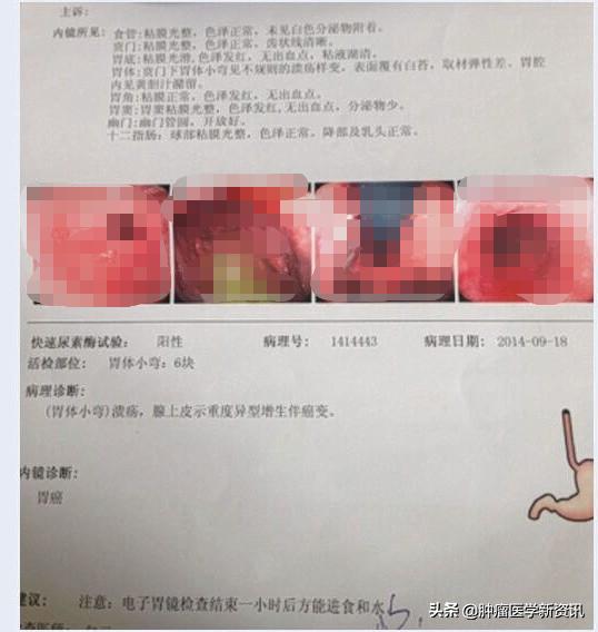 与胃癌做斗争,胃癌的治疗与前沿进展