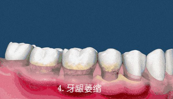 牙齿松动不是小事千万别忽视,牙齿松动不都是肾的事