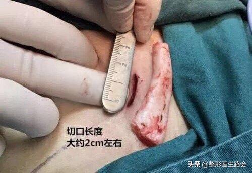 艺考生整容注意事项,艺考整形最佳方案