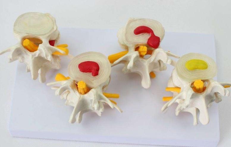 腰椎间盘突出血管瘤是怎么回事,椎管血管瘤