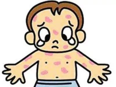 猩红热一定要吃够十天抗生素吗,猩红热为啥列为传染病