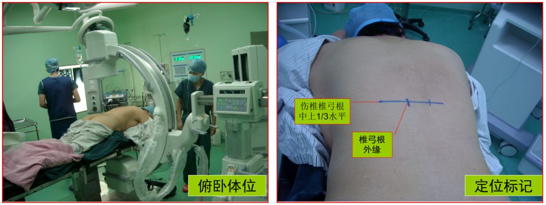 腰椎压缩骨折椎体成形术啥时候做,骨质疏松骨折椎体成形术操作步骤