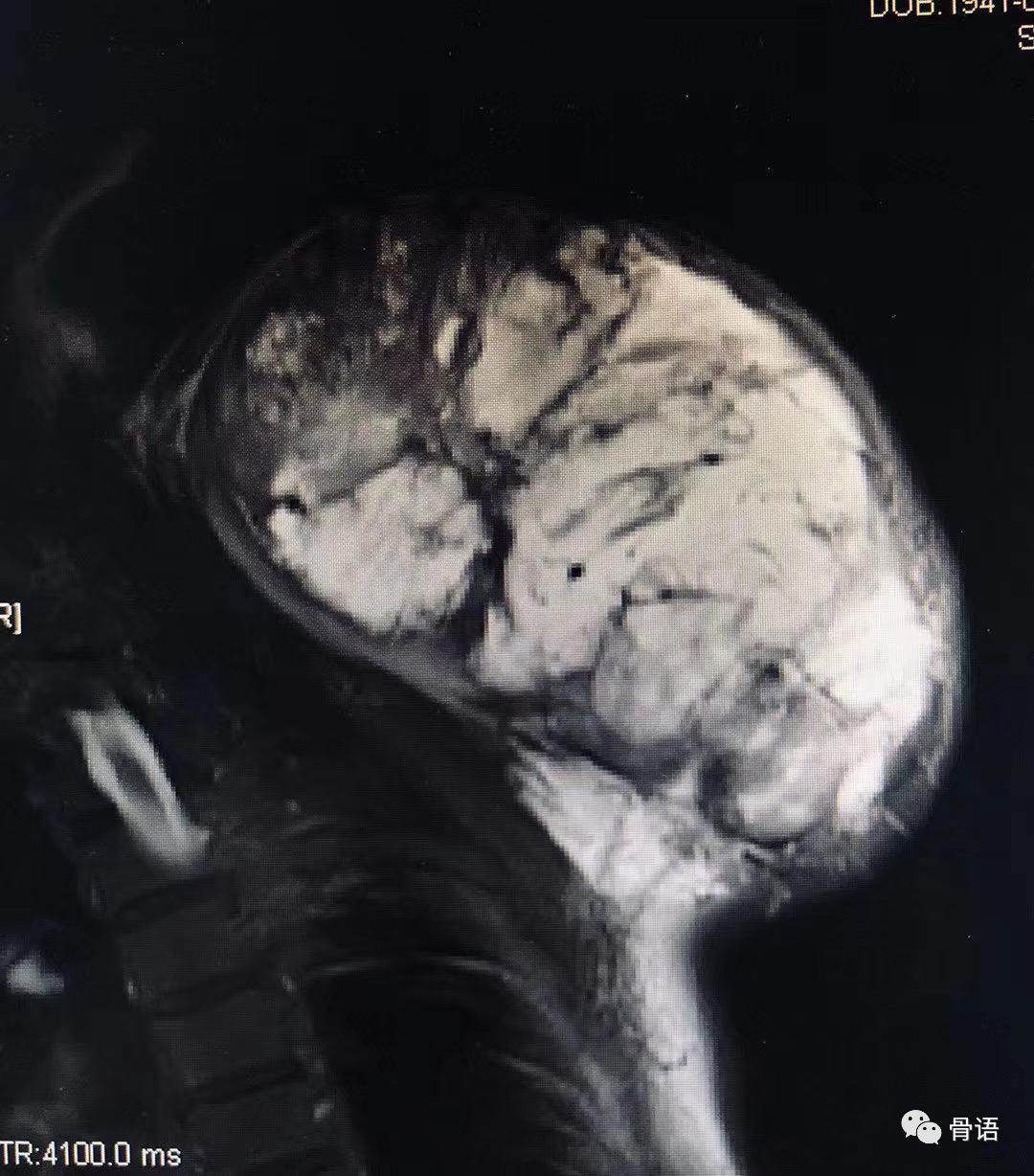 骨科恶性肿瘤,骨科软组织肉瘤是什么意思