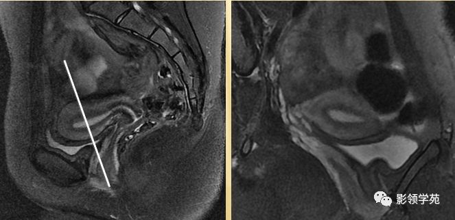 宫颈癌mri诊断,宫颈癌的mr扫描技术