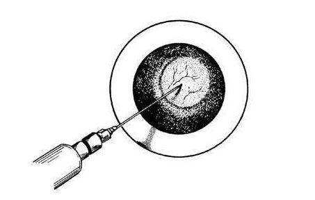 内痔怎么治，教你这个小妙招，让你不再菊花残