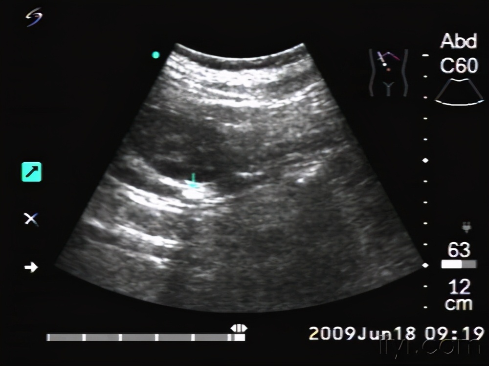 肾盂扩张积水吃什么药,肾积水伴输尿管结石病例