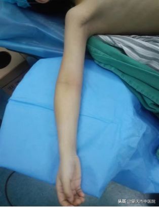 小孩子骨折和成人骨折有什么区别,小孩常见骨折类型