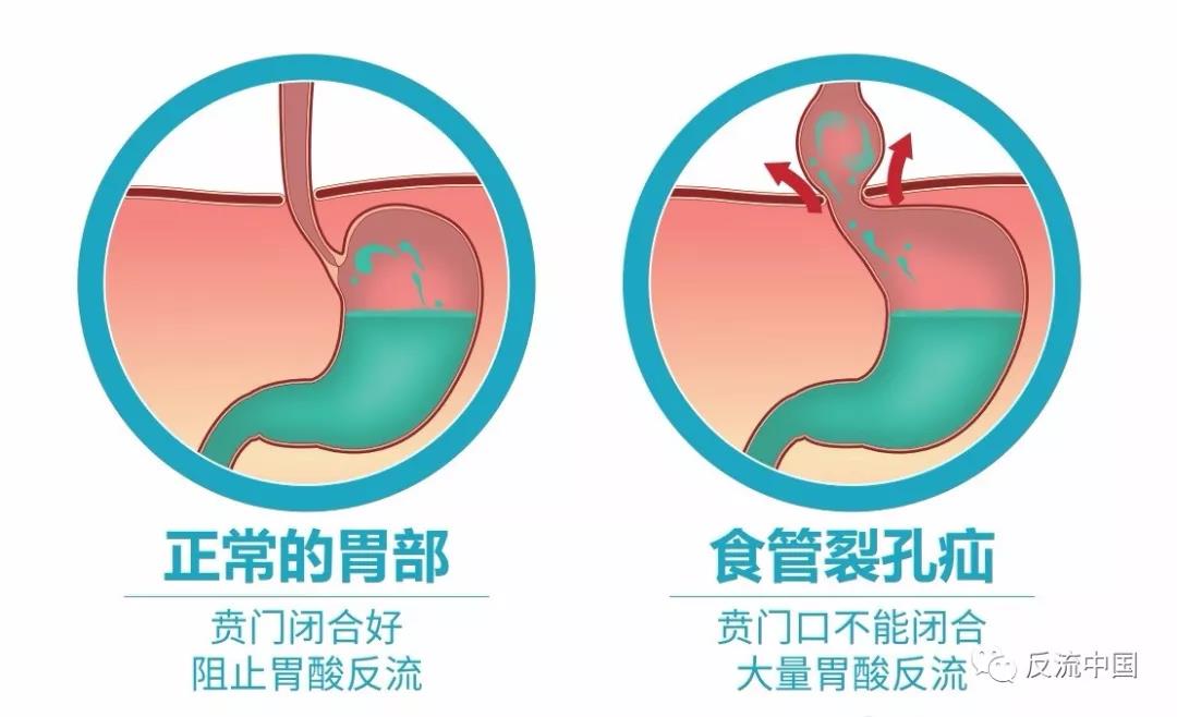 反酸烧心吃雷贝拉唑没效果怎么办,胃反酸烧心吃奥美拉唑可以吗