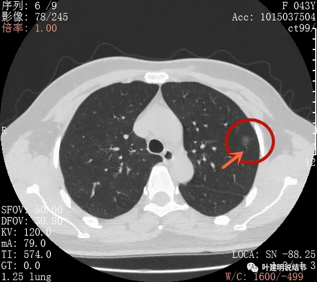 怎样从病理报告看是不是原位癌,原位腺癌切除子宫要开刀吗