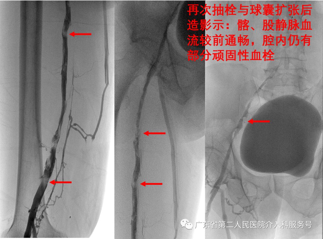 左腿血栓的最快消除方法,左腿浮肿有血栓用什么药治疗