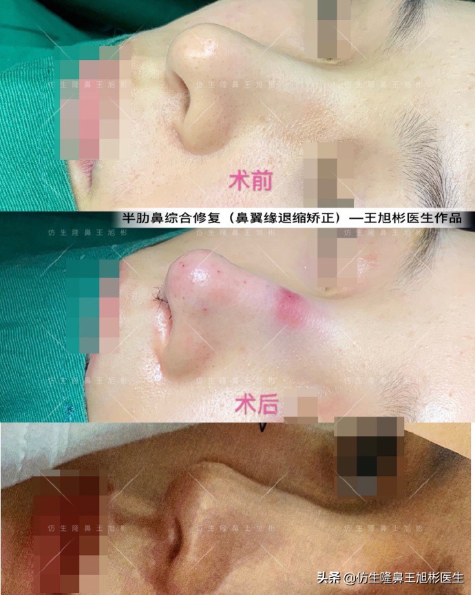 隆鼻的鼻翼怎么修复,隆鼻后多久可以做鼻翼缘矫正