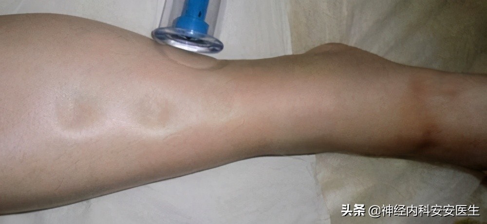 产后手脚浮肿是什么原因,怀孕手脚浮肿是什么原因引起的