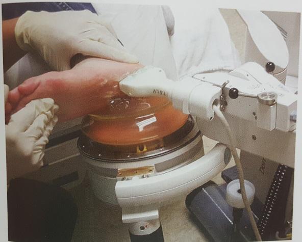 专业长跑队员有足底筋膜炎吗,长跑怎么避免足底筋膜炎