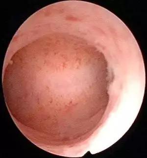 避孕环放子宫不掉吗,子宫放节育环的原理