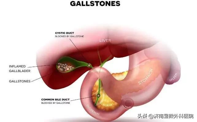胆囊结石1.4厘米能保胆取石么,胆囊结石一厘米可以保胆取石吗