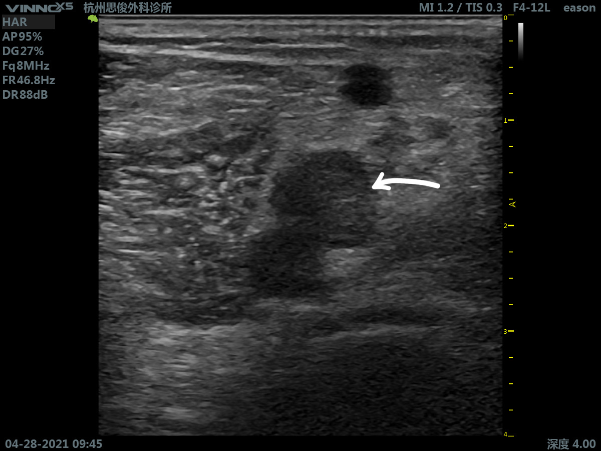 小腿深静脉血栓多久才可以痊愈,深静脉血栓形成的诊断和治疗指南