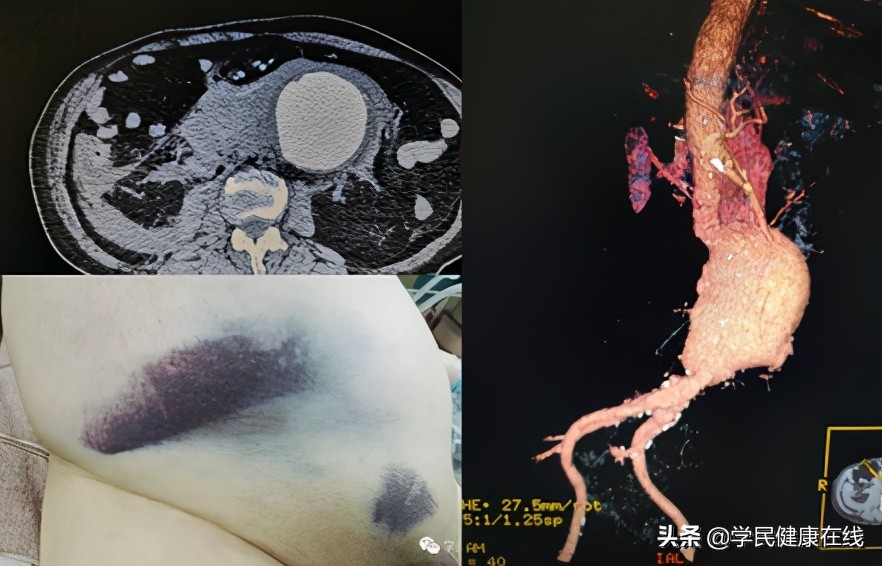 血管外科介入新技术,21世纪血管外科发展方向微创治疗
