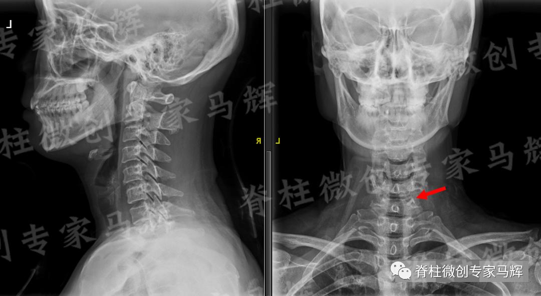 脊椎狭窄压迫神经腿疼怎么治疗,神经根痛上肢麻木怎么康复