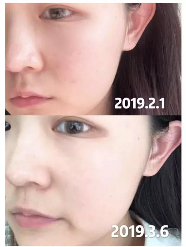 日本的美白针,日本最强美白针