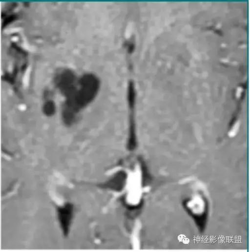 各种囊肿的症状,颅内囊肿18-19mm严重吗