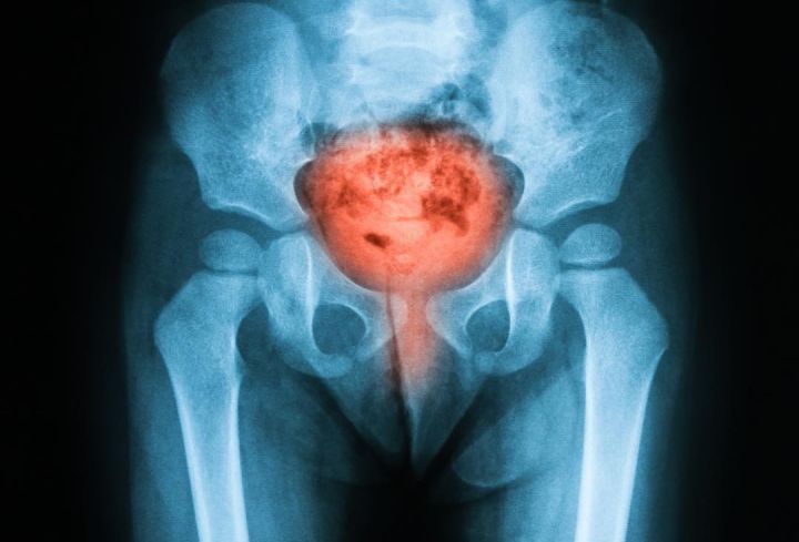 老人尿不出导尿能行吗,卧床老人憋尿尿不出来怎么办