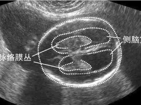 孕妇四维显示侧脑室正常高值,两侧脑室间见透明隔腔