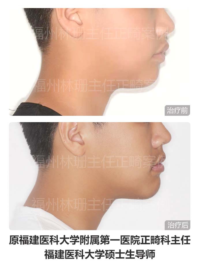 牙齿矫正仍然没整齐,异位正常牙齿矫正不过来怎么办