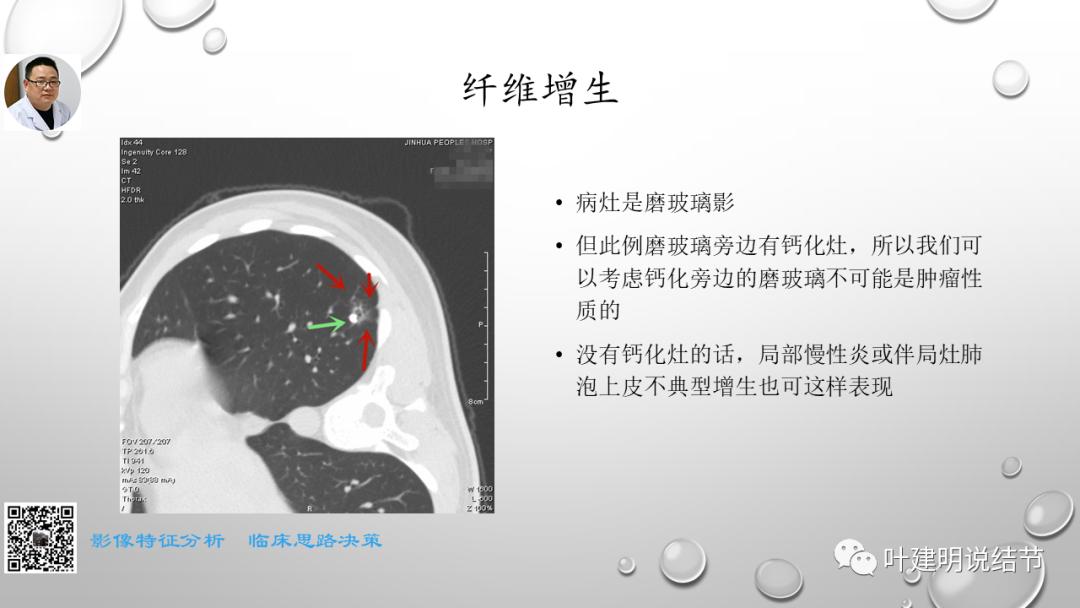 叶建明谈肺实性小结节视频,廖正银教授谈肺结节