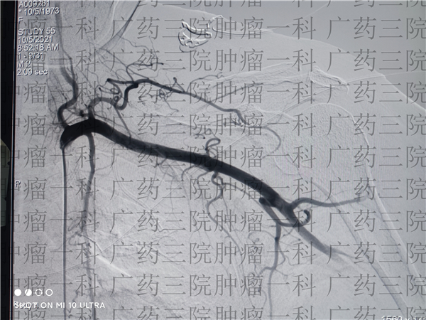 乳腺癌陈女士近况,广药三院癌症怎么转移