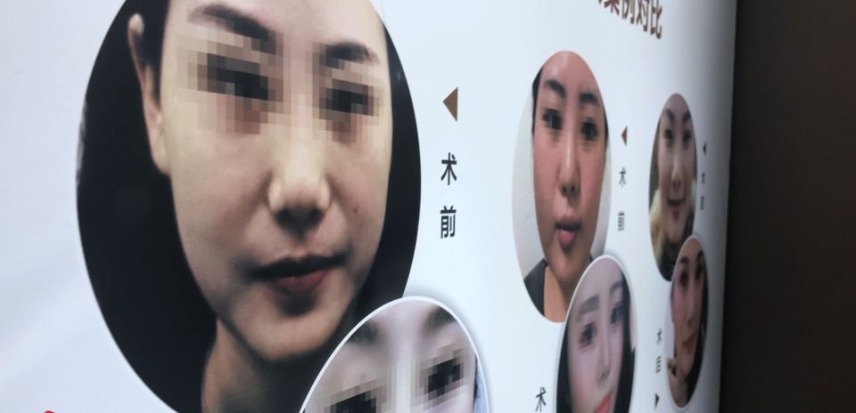 打近6万的美容针女子竟惨遭毁容,女子花4万打美容针没效果